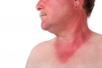 Diagnose Sonnenbrand